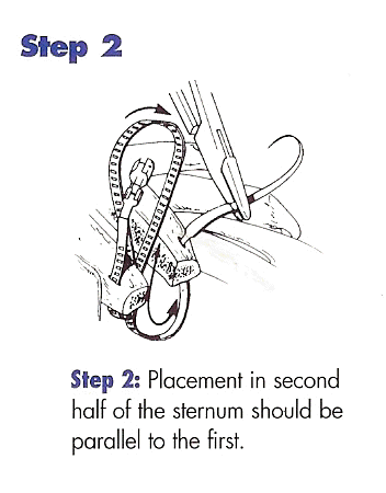 Step 2: Placement in second half of the sternum should be parallel to the first.
