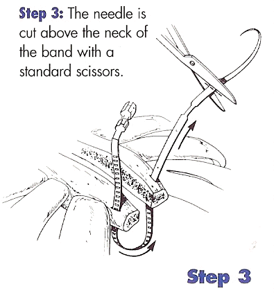 Step 3: The needle is cut above the neck of the band with scissors.